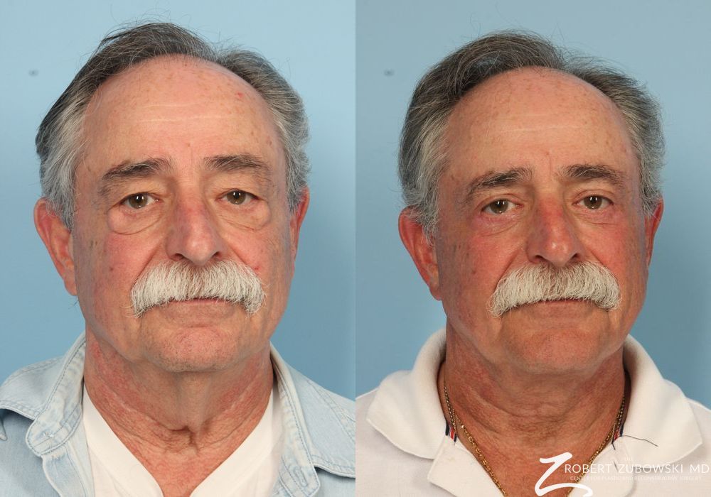 Neck Lift - Case 3846