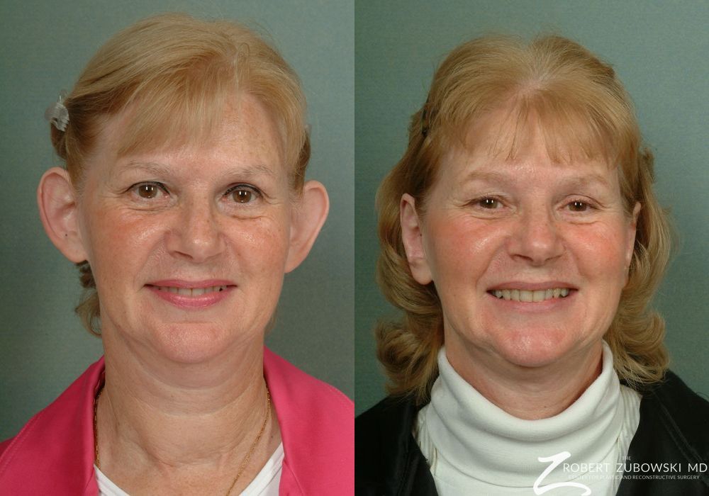 Otoplasty - Case 3855