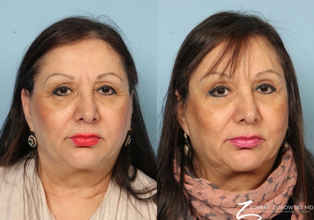 Brow Lift - Case 3789