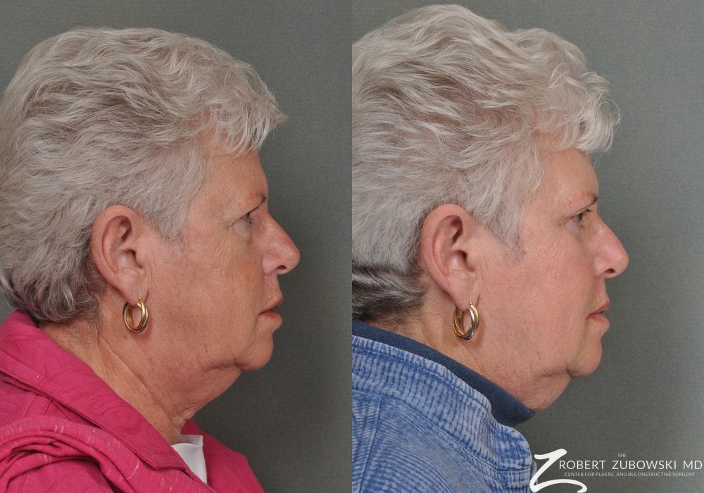 Blepharoplasty - Thumbnail 2