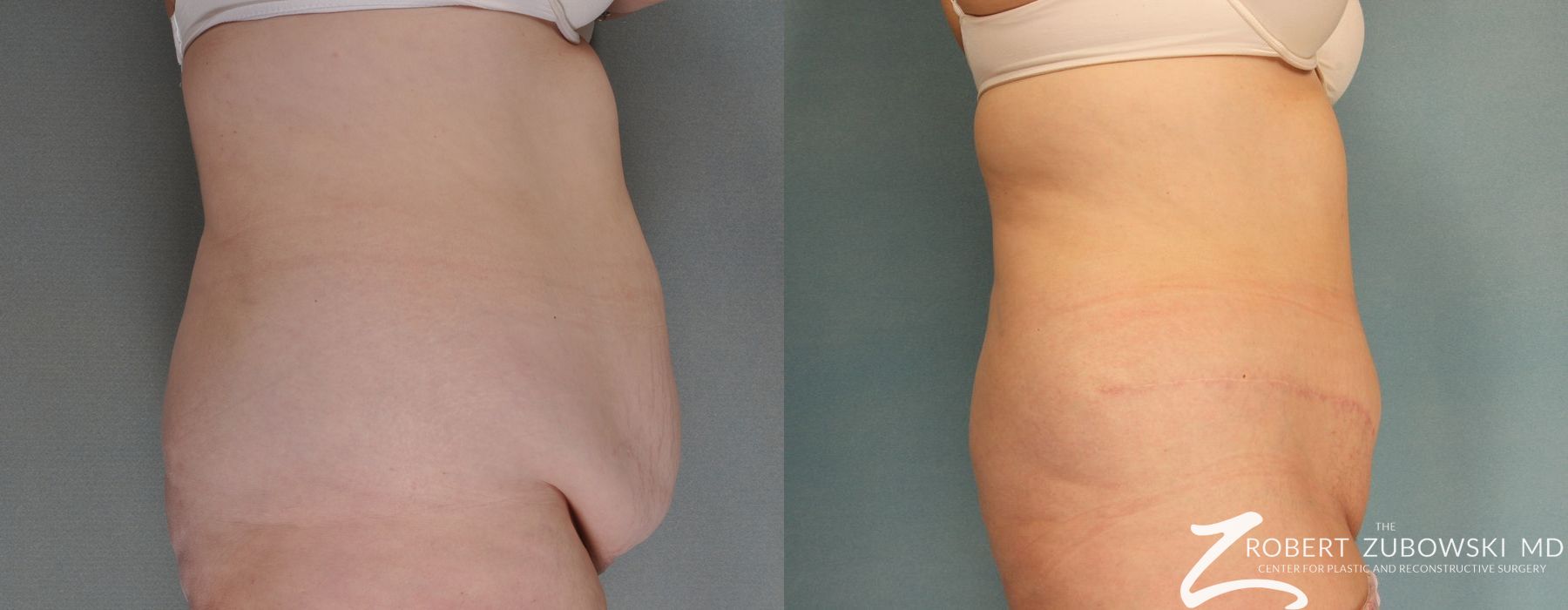 Tummy Tuck - Thumbnail 2