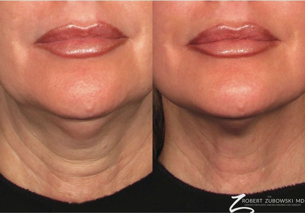 Ultherapy® - Case 3929