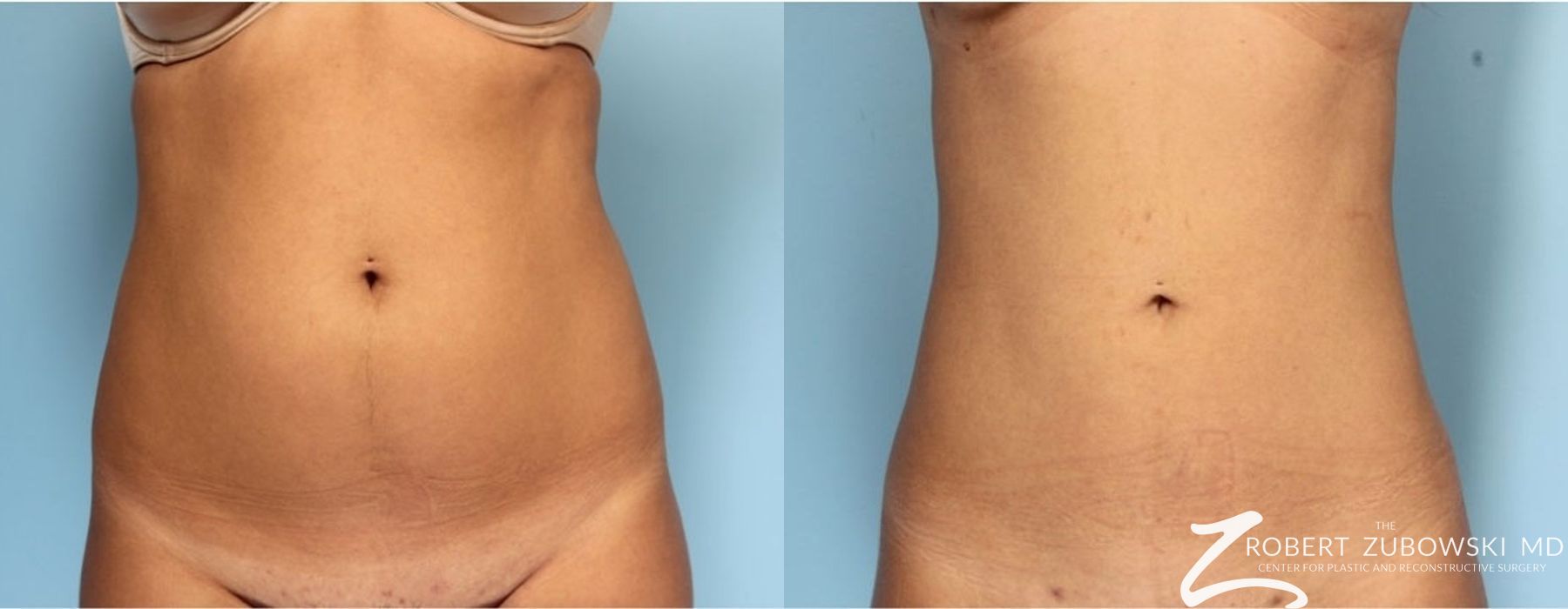 Liposuction - Case 3561
