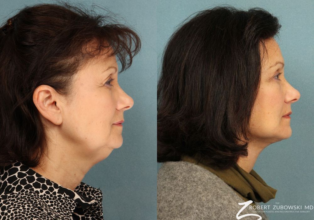 Facelift - Thumbnail 2