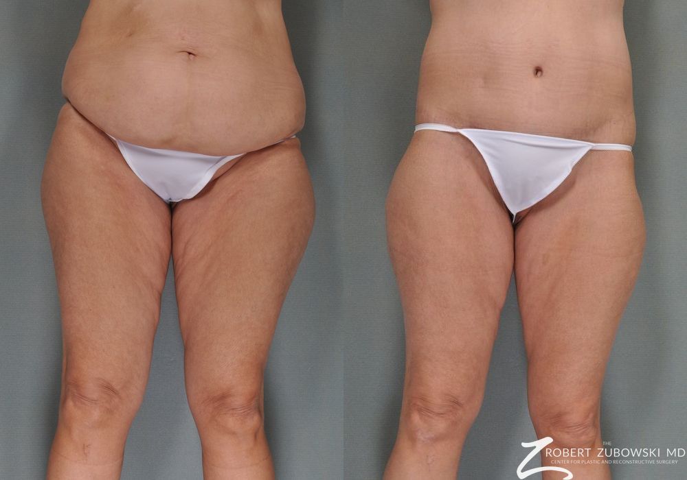 Body Lift - Case 3504