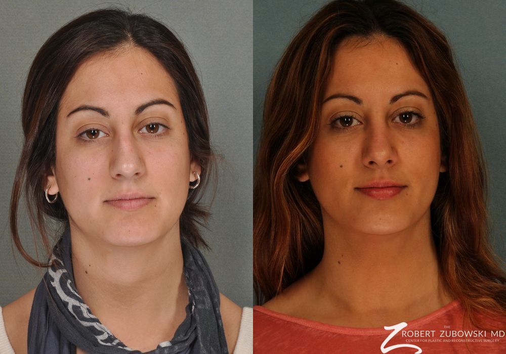 Rhinoplasty - Case 3886