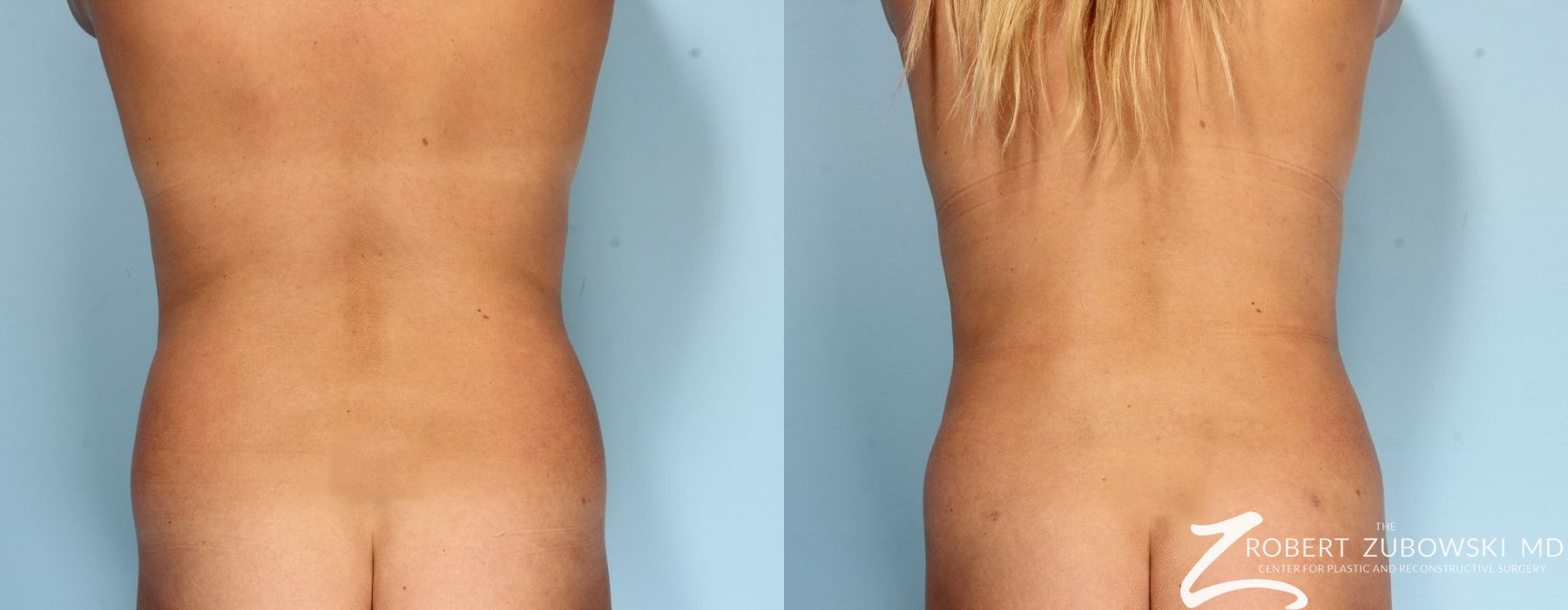 Liposuction - Case 3567