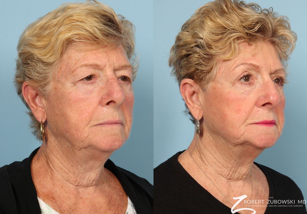 Blepharoplasty - Thumbnail 2