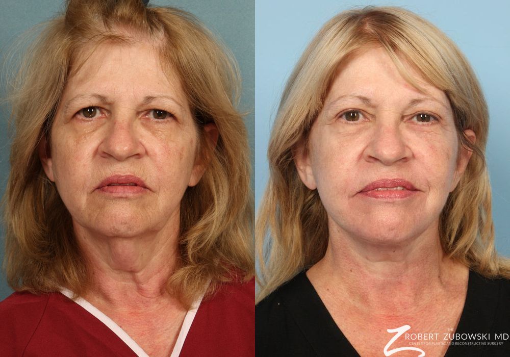 Facelift - Case 3817