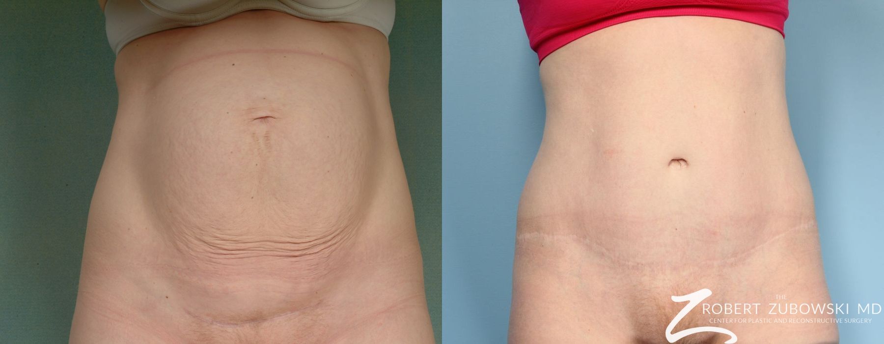 Tummy Tuck - Case 3577