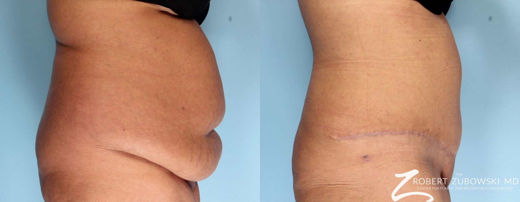 Tummy Tuck - Thumbnail 2