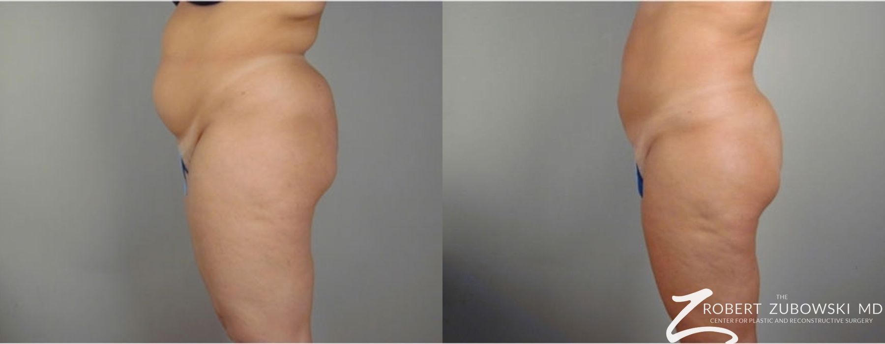 Liposuction - Thumbnail 2