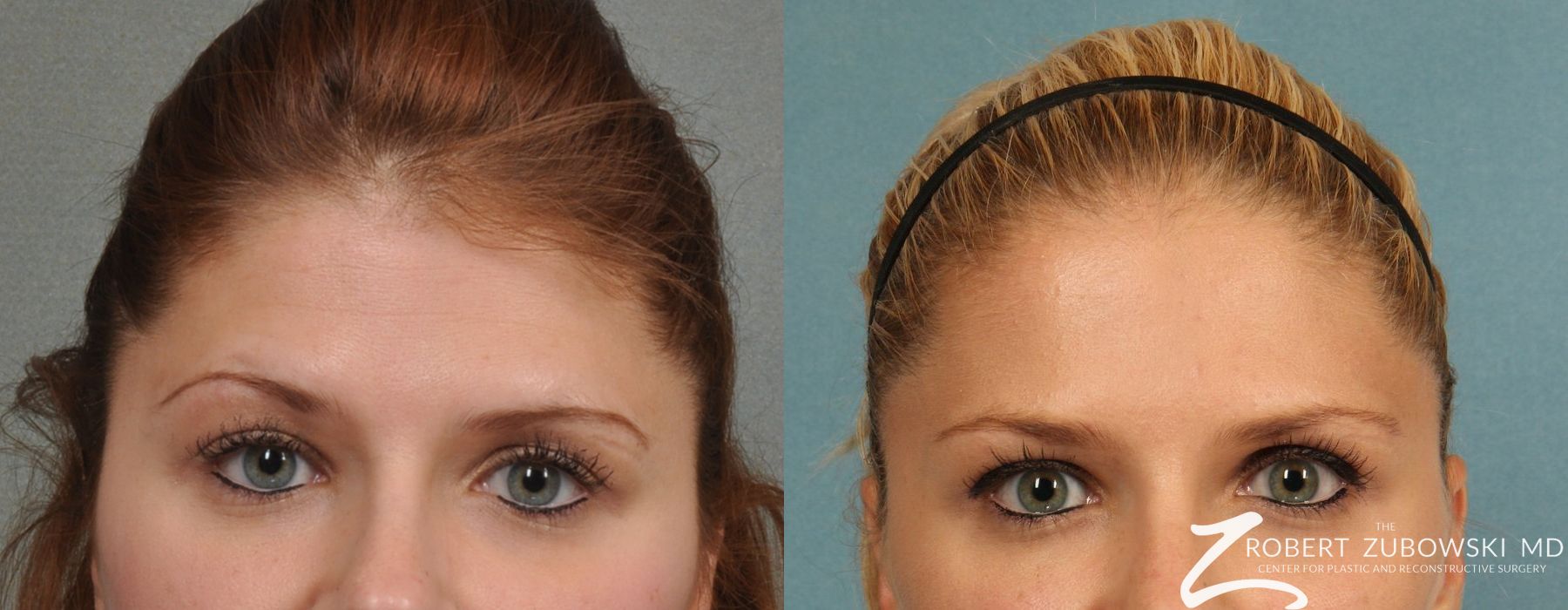 BOTOX® Cosmetic - Case 3901
