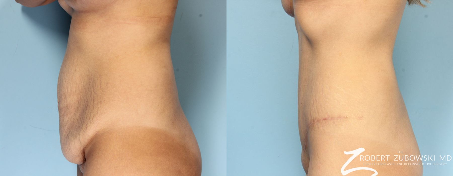 Tummy Tuck - Thumbnail 2