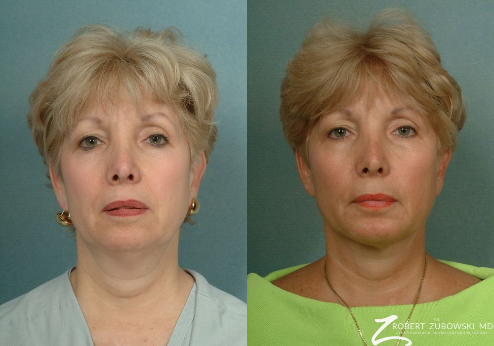 Neck Lift - Case 3842