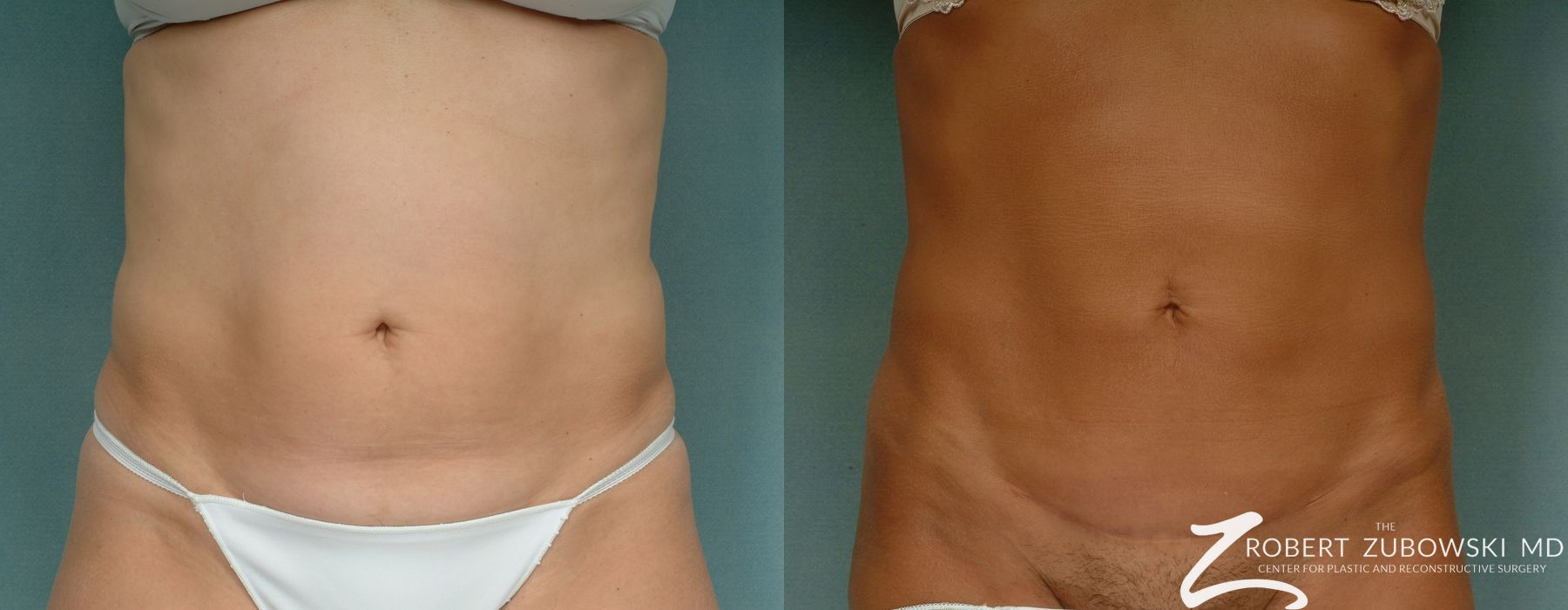 Liposuction - Case 3554