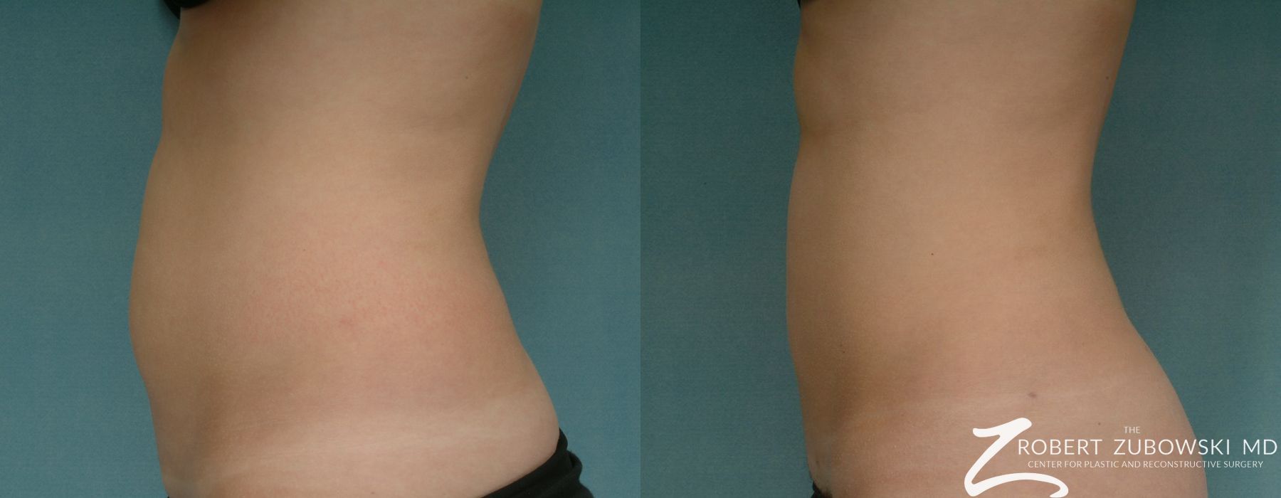 Liposuction - Thumbnail 3