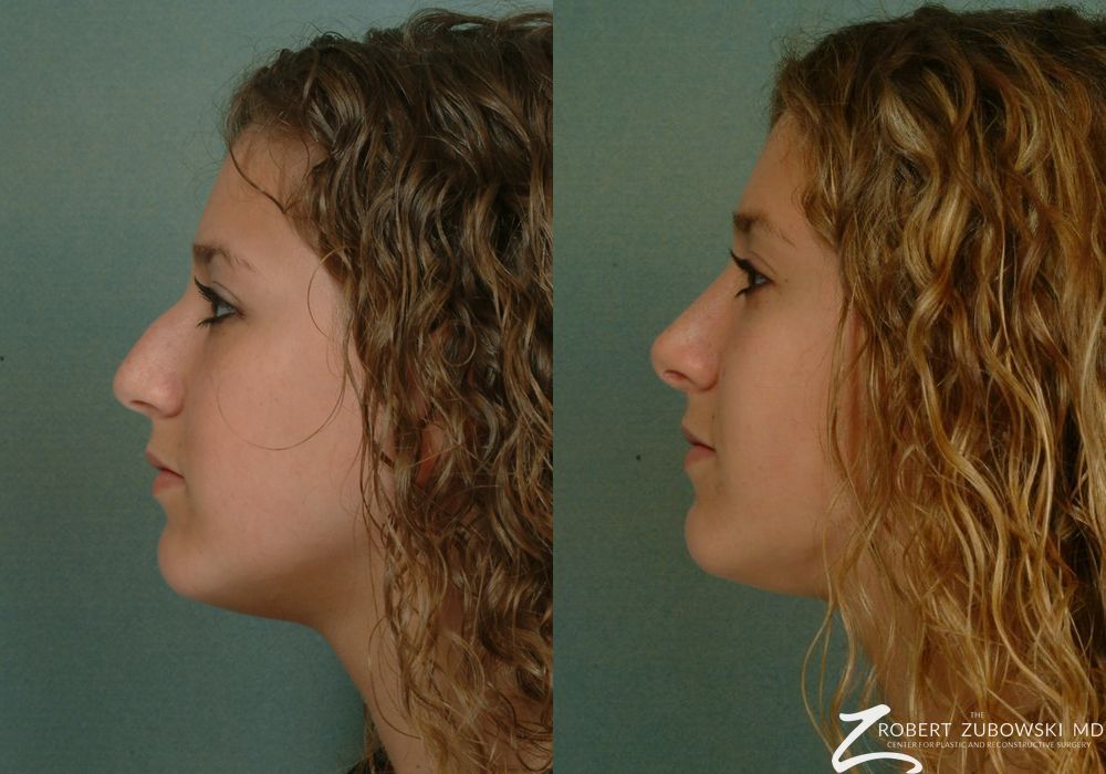 Rhinoplasty - Thumbnail 2