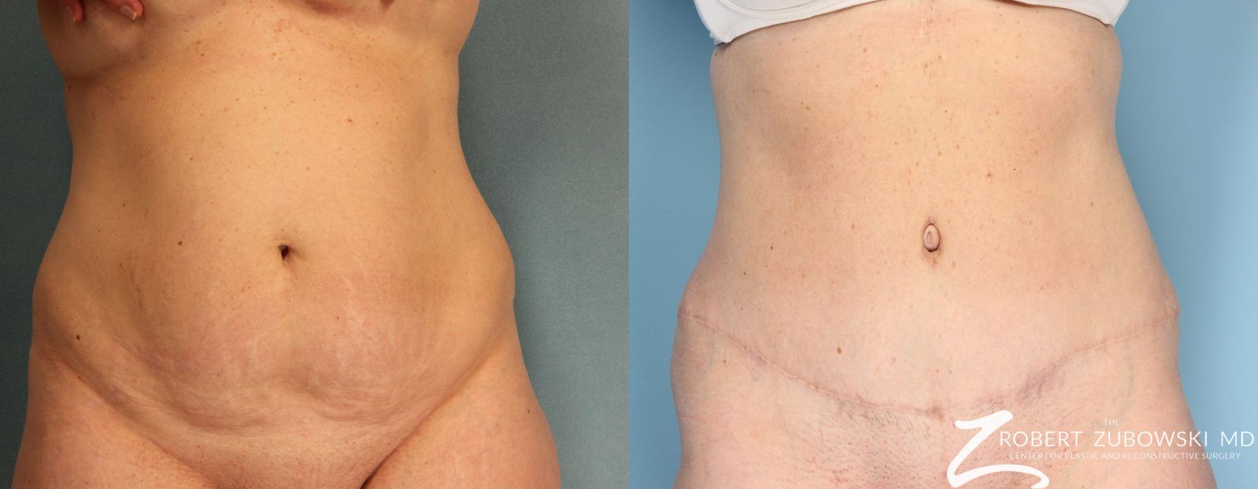 Tummy Tuck - Case 3588