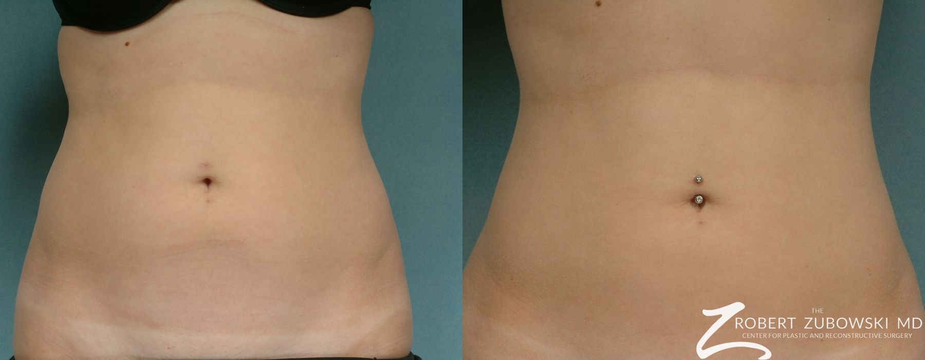 Liposuction - Case 3552