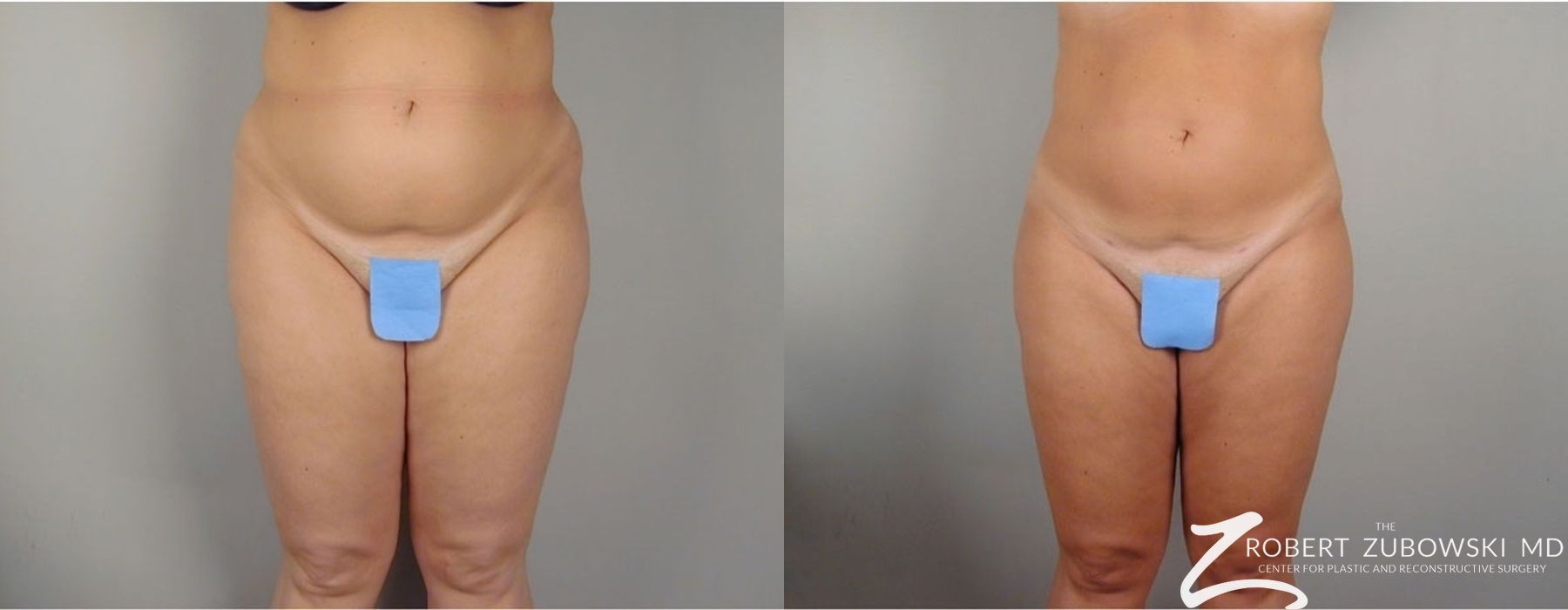 Liposuction - Case 3562