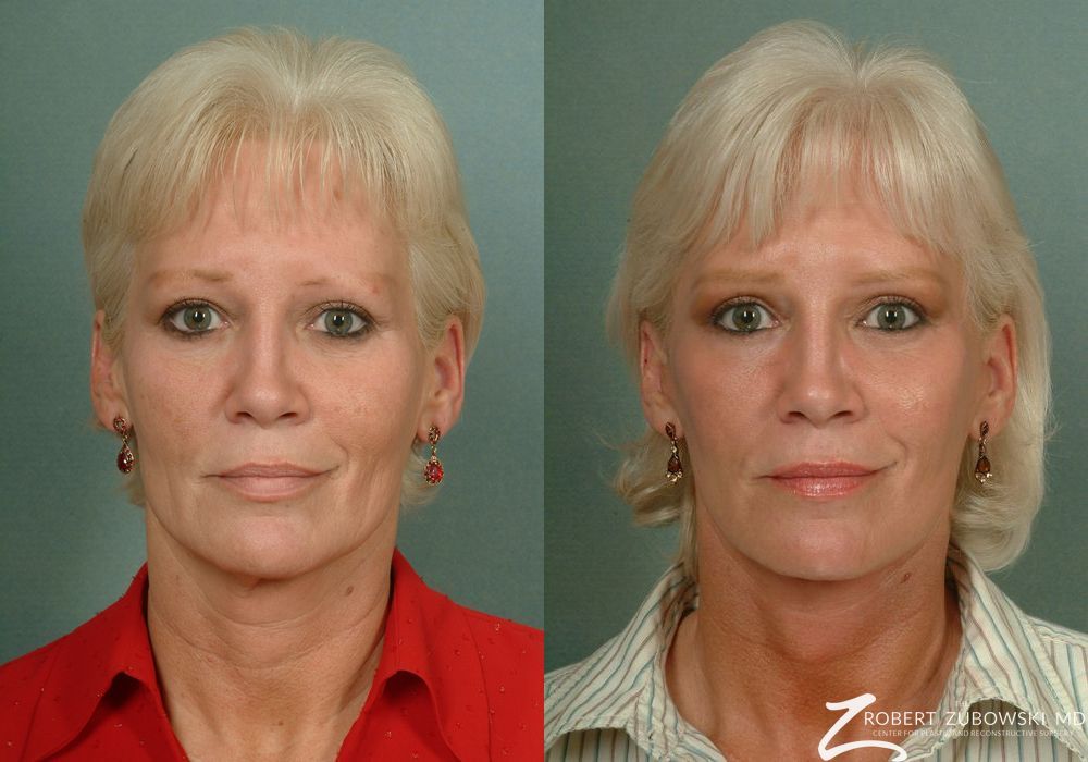 Facelift - Case 3807