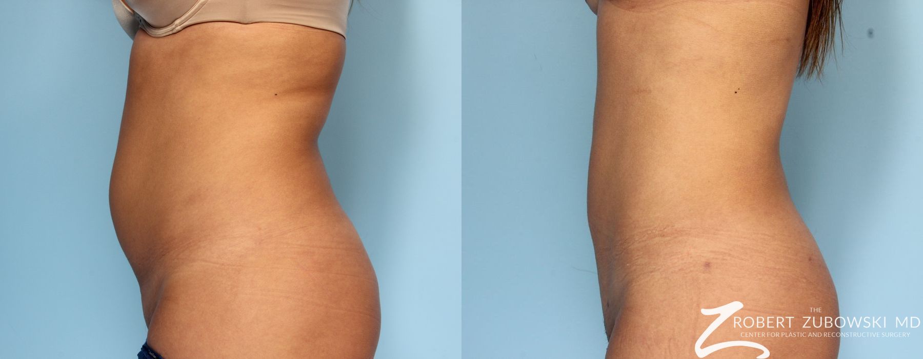Liposuction - Case 3533