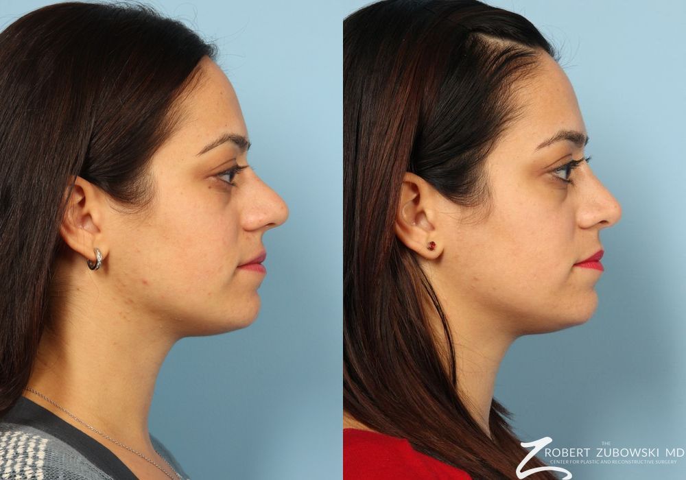 Rhinoplasty - Thumbnail 2