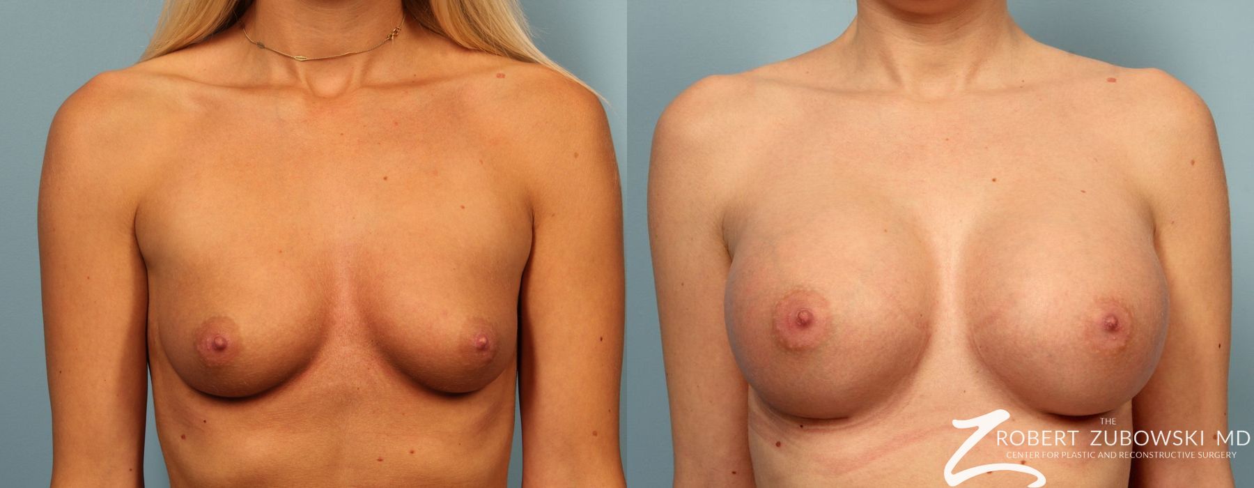 Before and after procedure result