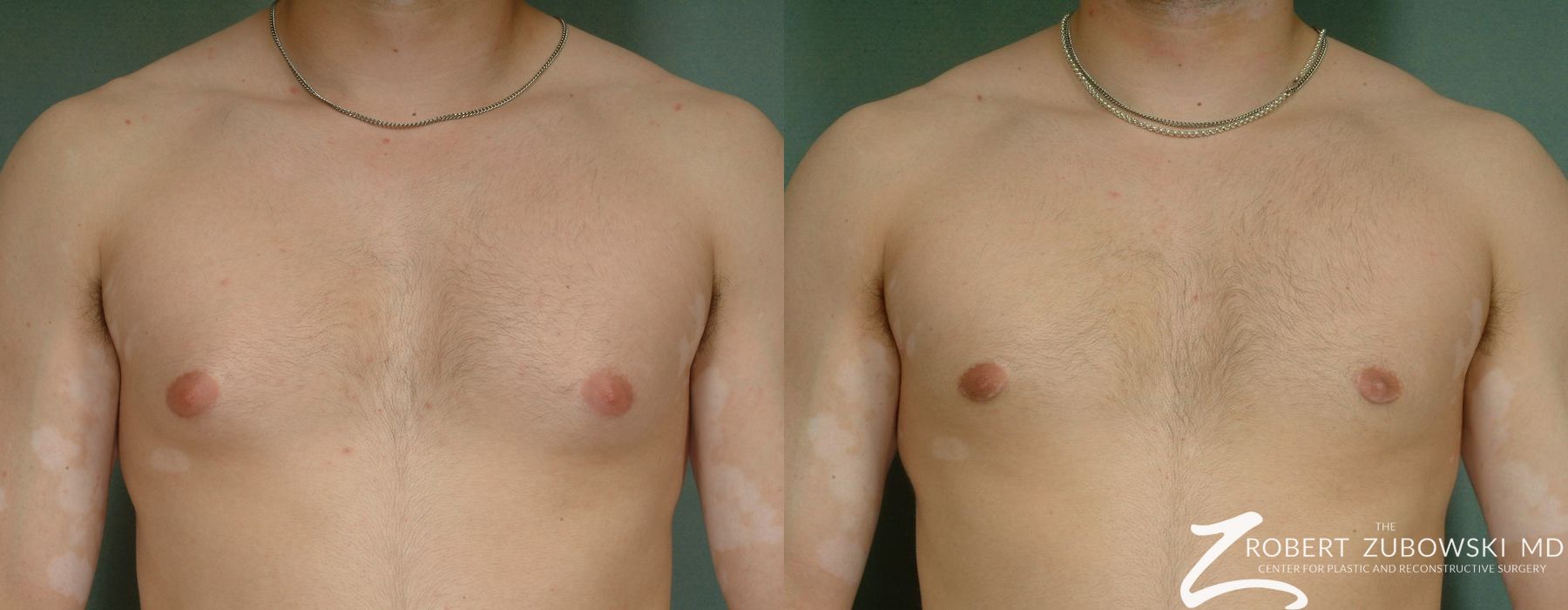Gynecomastia - Case 3728