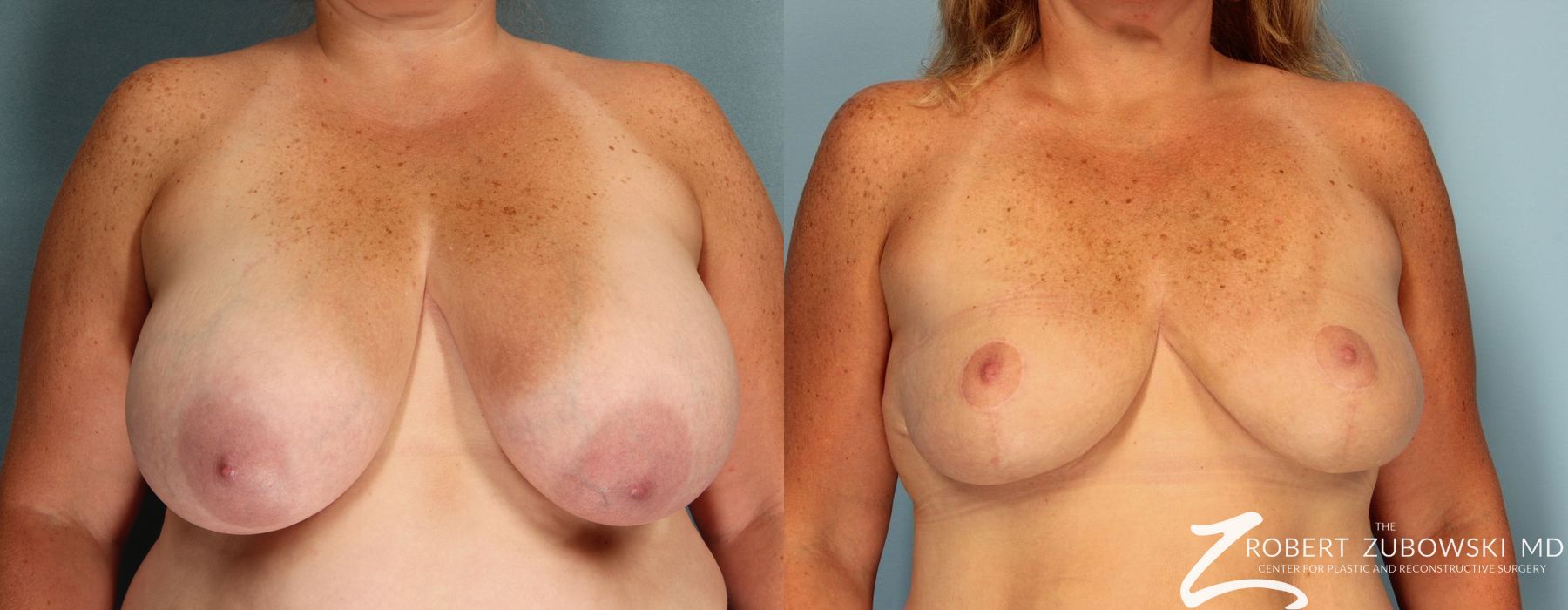 Breast Lift and Augmentation - Case 3668