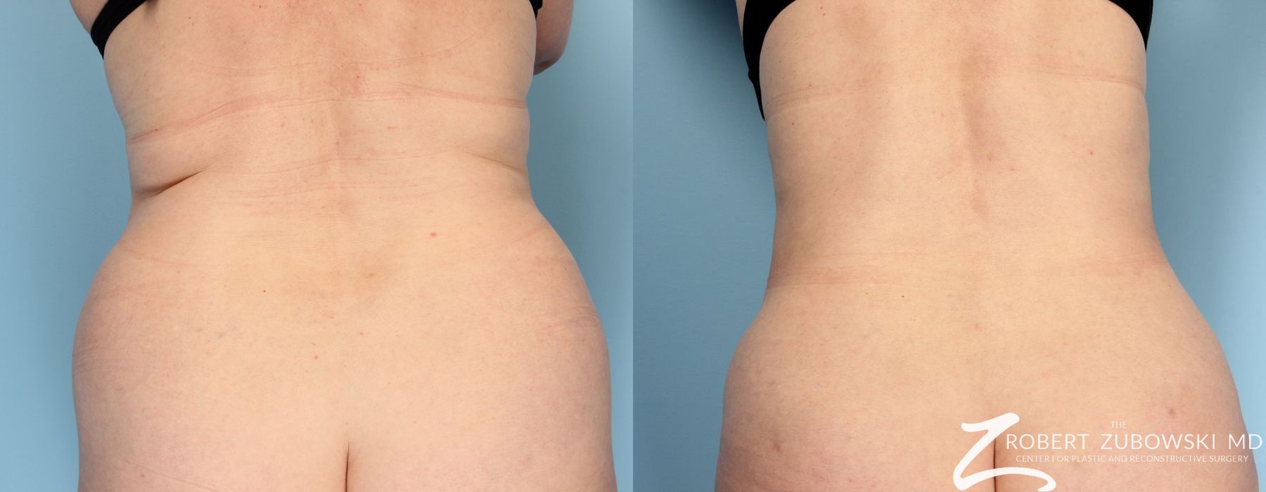 Liposuction - Case 3535