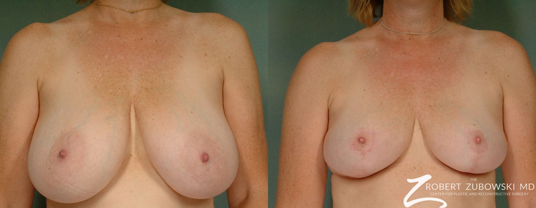 Breast Reduction - Case 3705