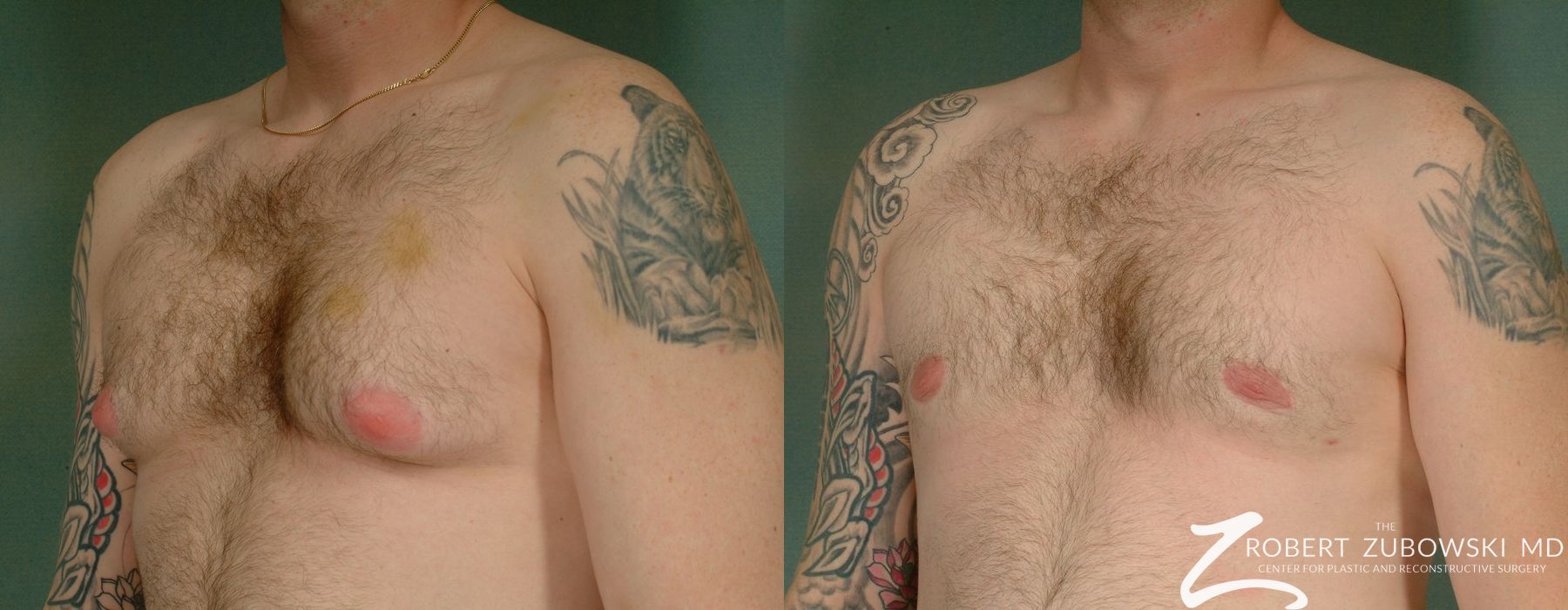 Gynecomastia - Thumbnail 2