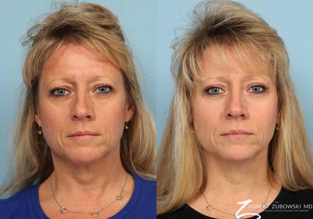 Blepharoplasty - Case 3738