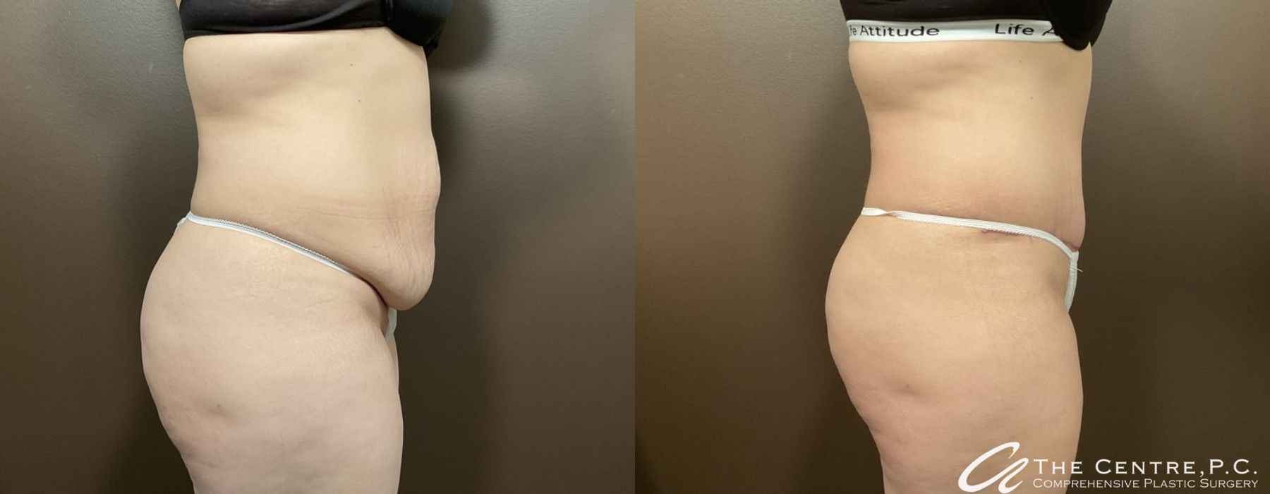 Abdominoplasty - Thumbnail 2