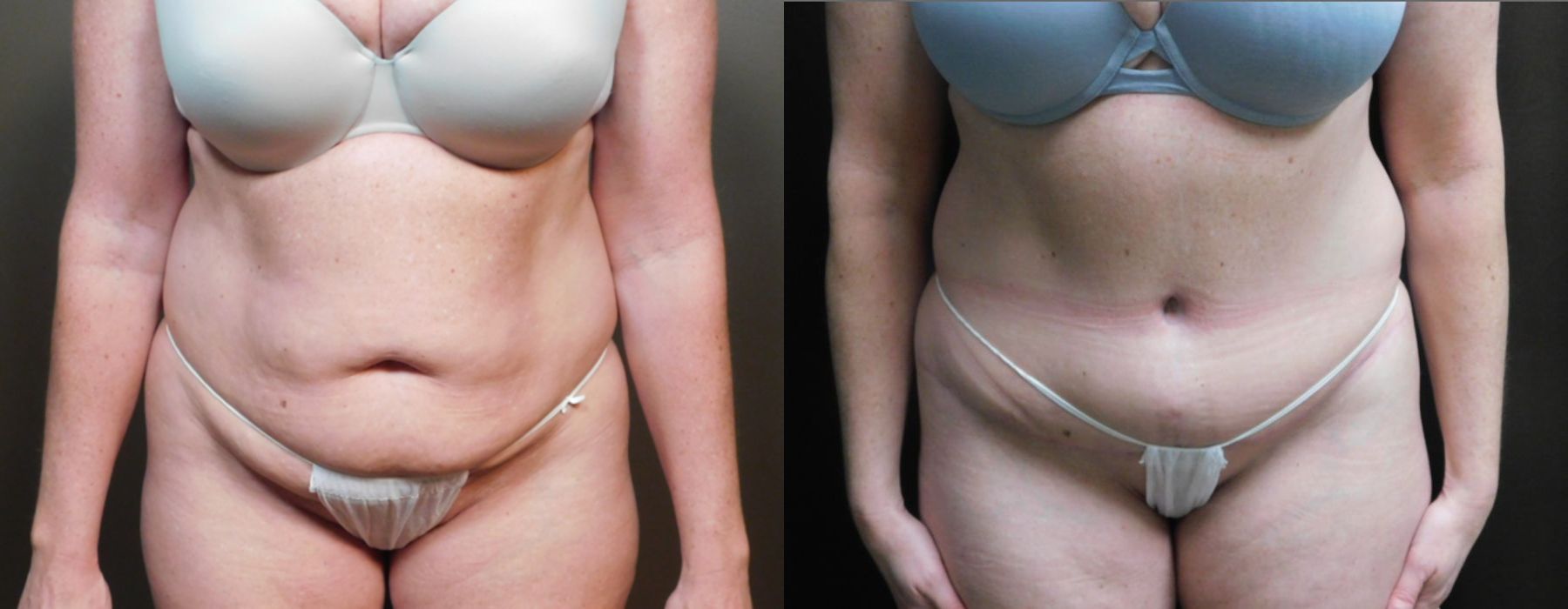 Abdominoplasty - Case 3415