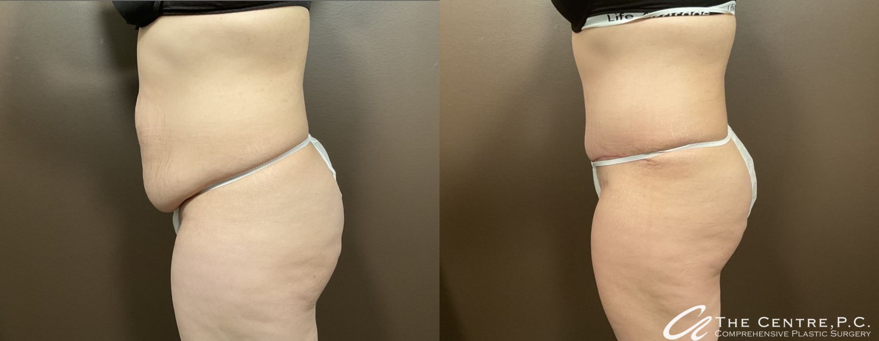 Abdominoplasty - Thumbnail 3