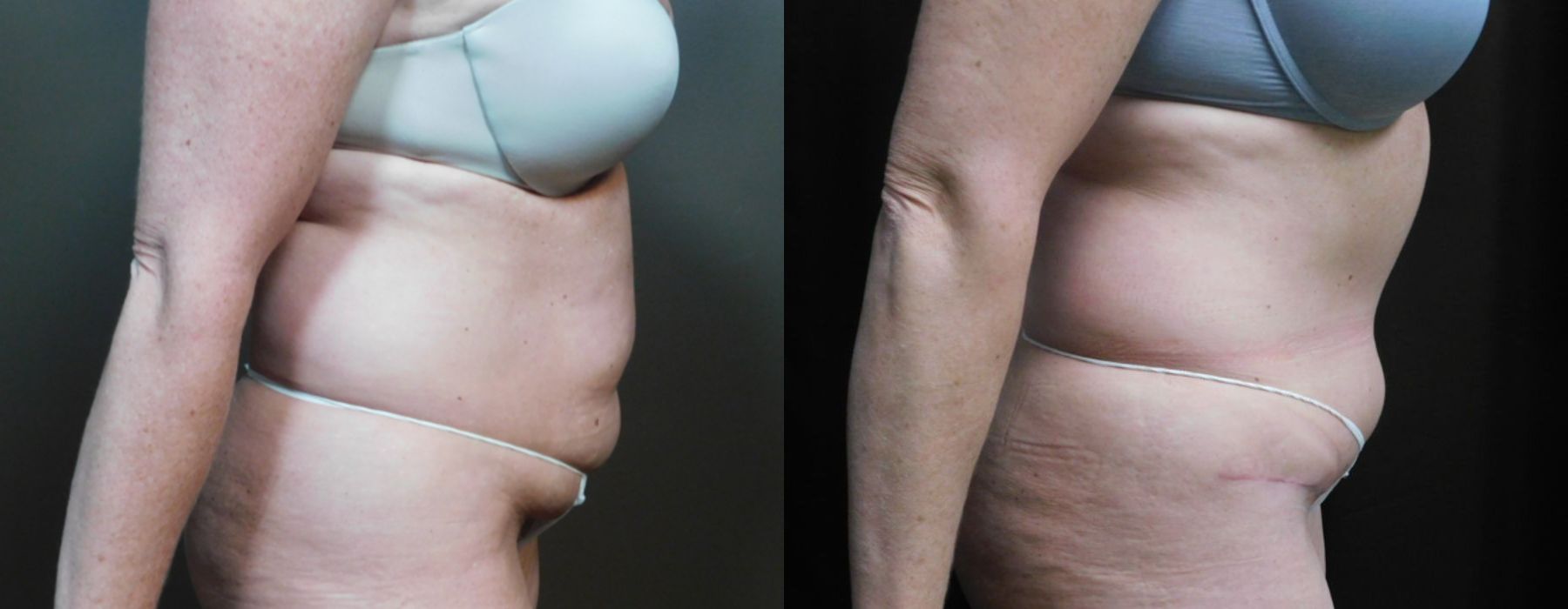 Abdominoplasty - Thumbnail 2