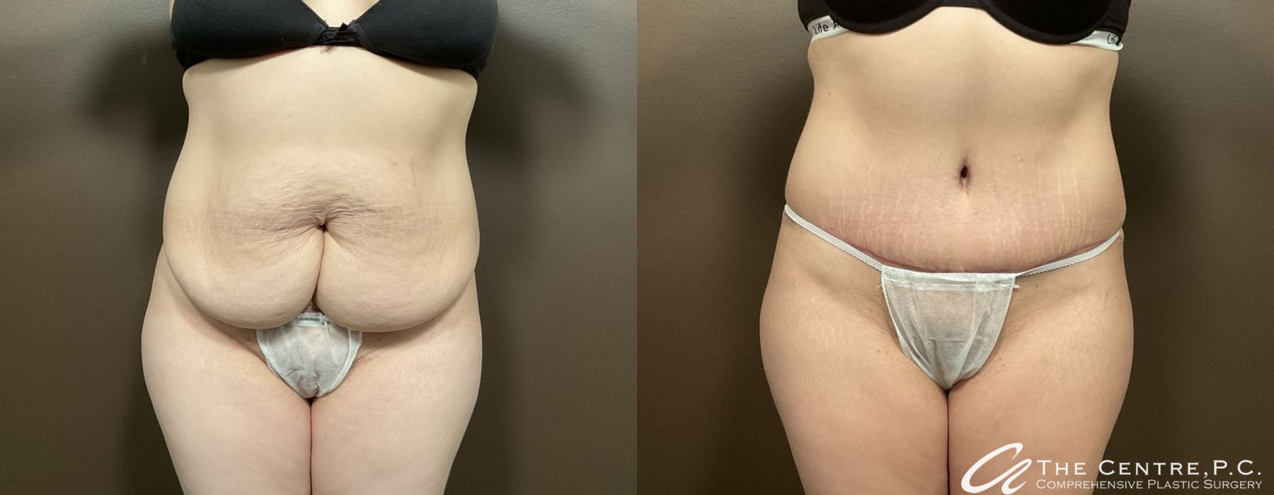 Abdominoplasty - Case 3306