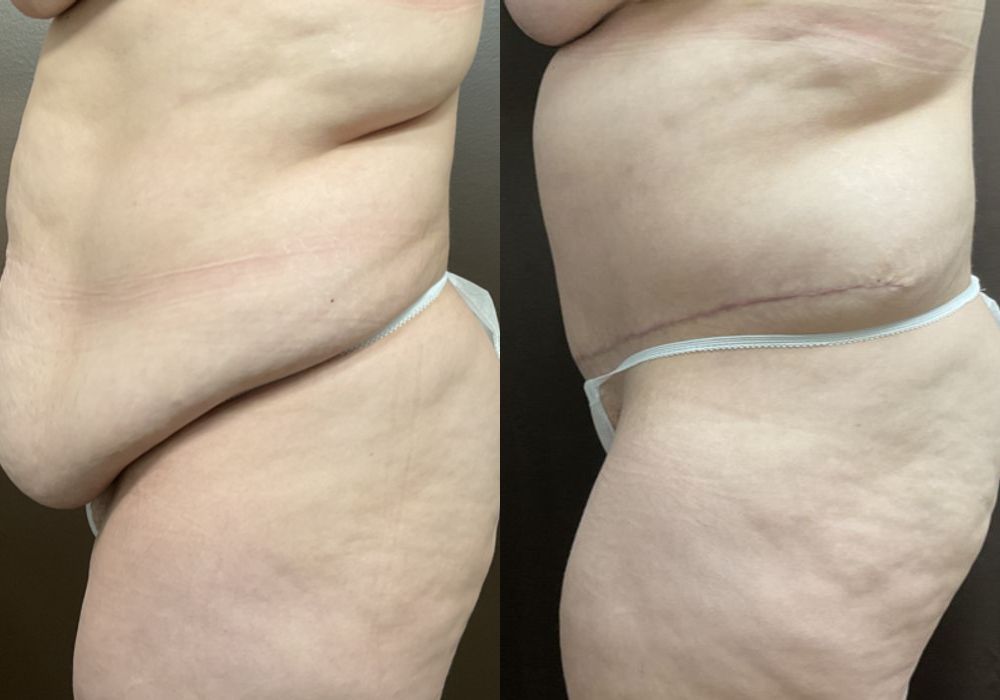 Abdominoplasty - Thumbnail 3