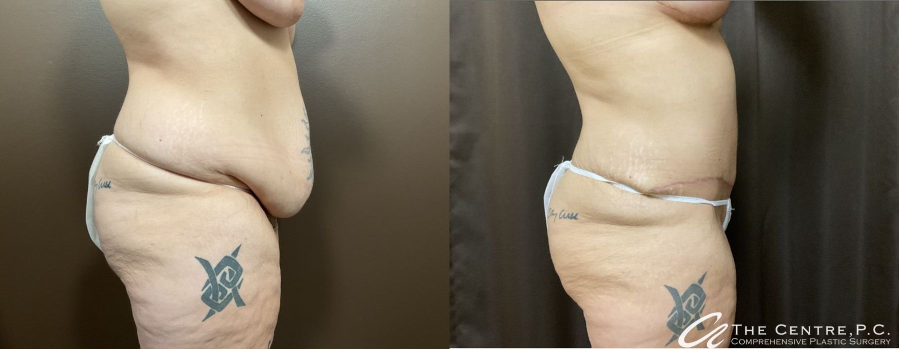 Before and after Abdominoplasty case 9972 - Angle 2