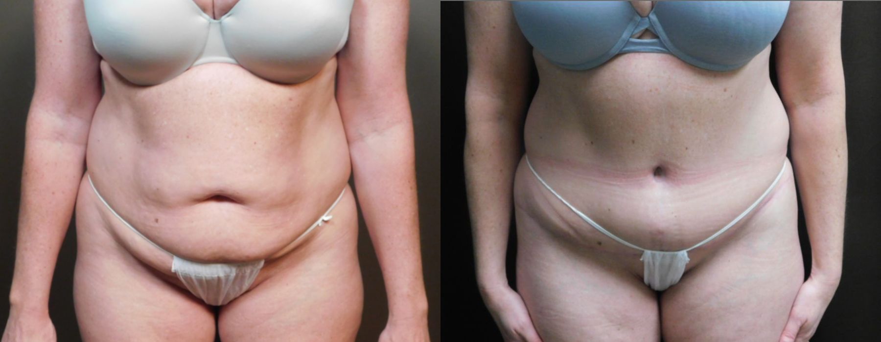 Before and after Liposuction case 10982