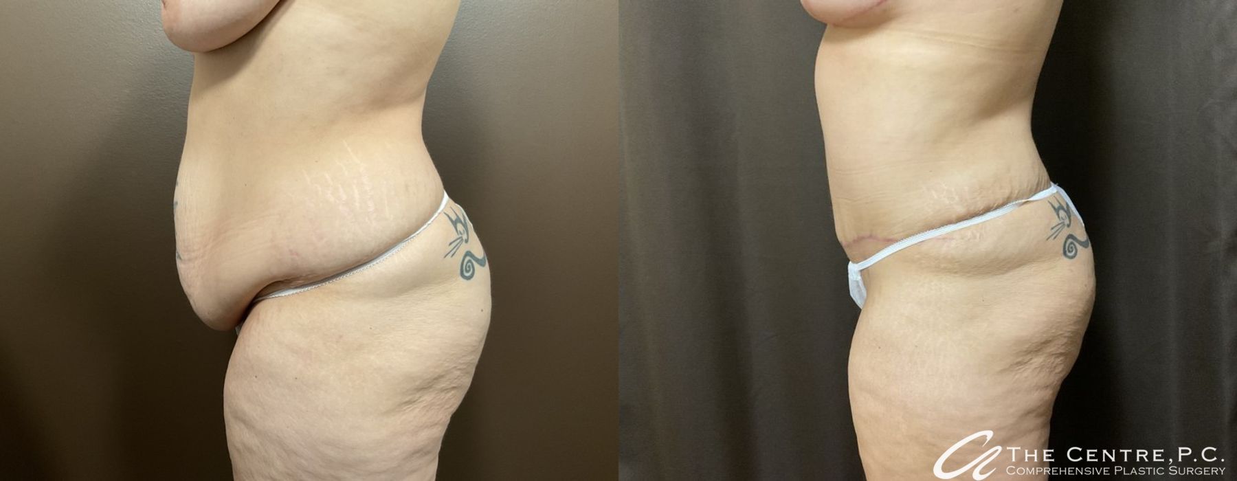 Before and after Abdominoplasty case 9972 - Angle 3