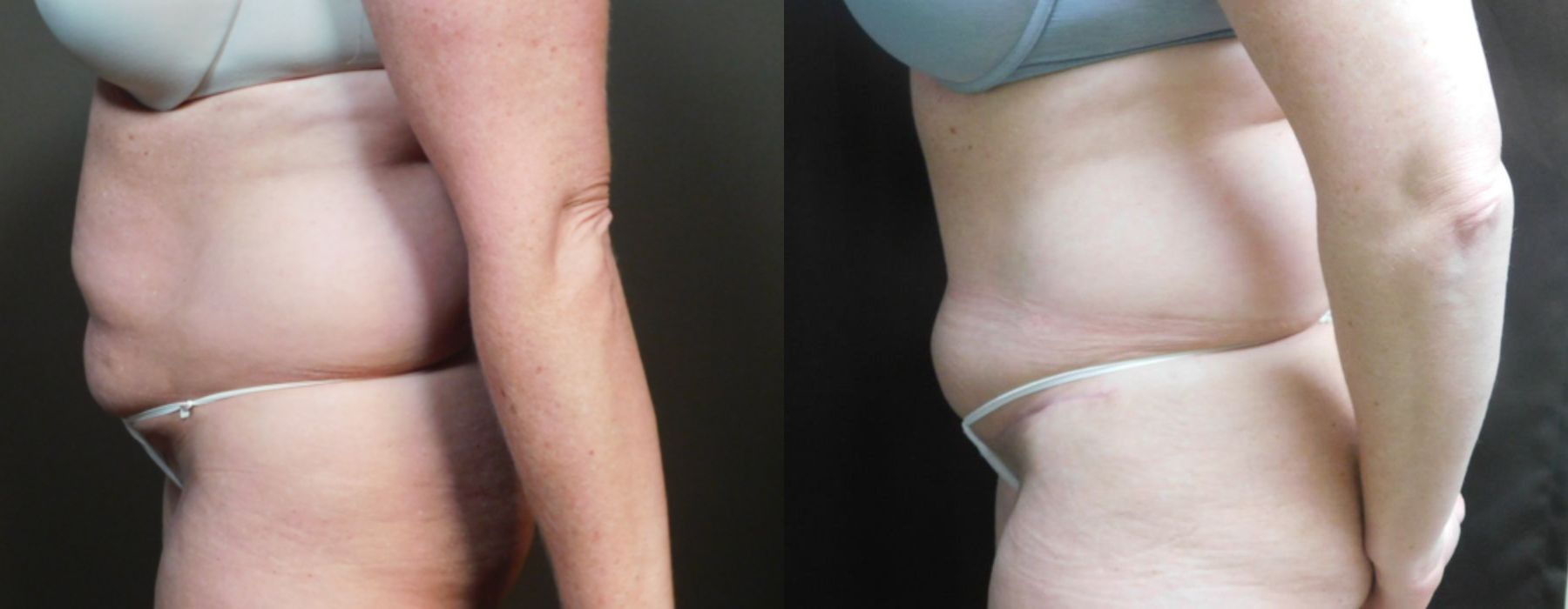 Before and after Liposuction case 10982 - Angle 3