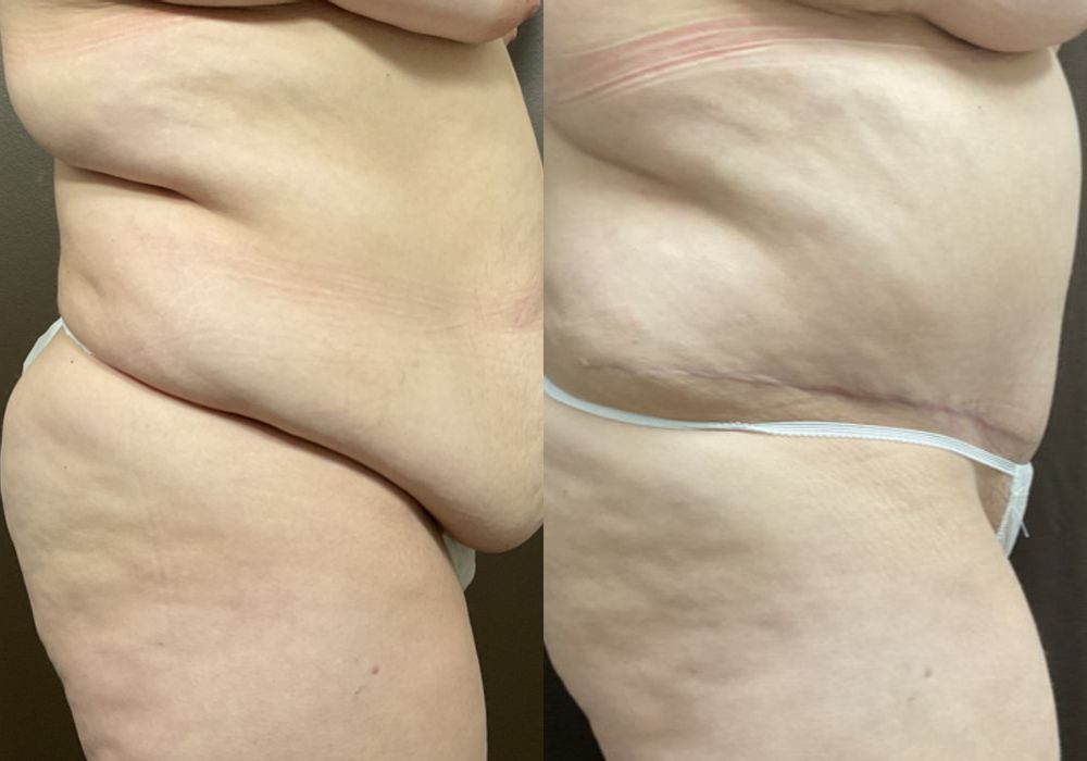 Abdominoplasty - Thumbnail 2