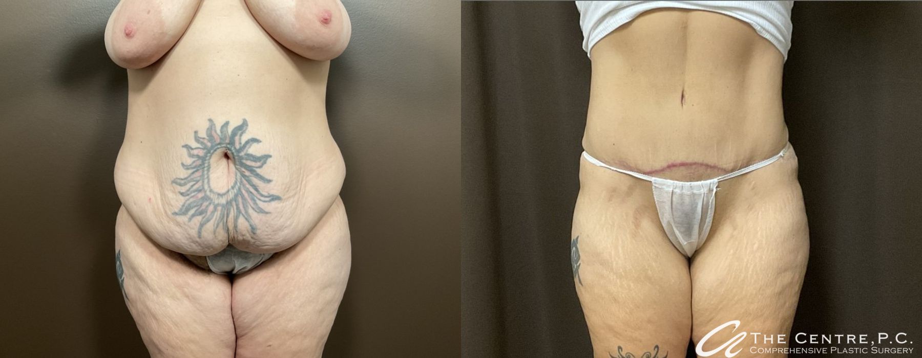 Before and after Abdominoplasty case 9972