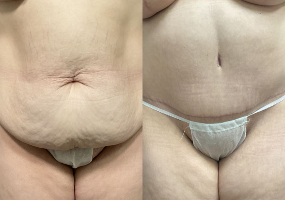 Abdominoplasty - Case 3308