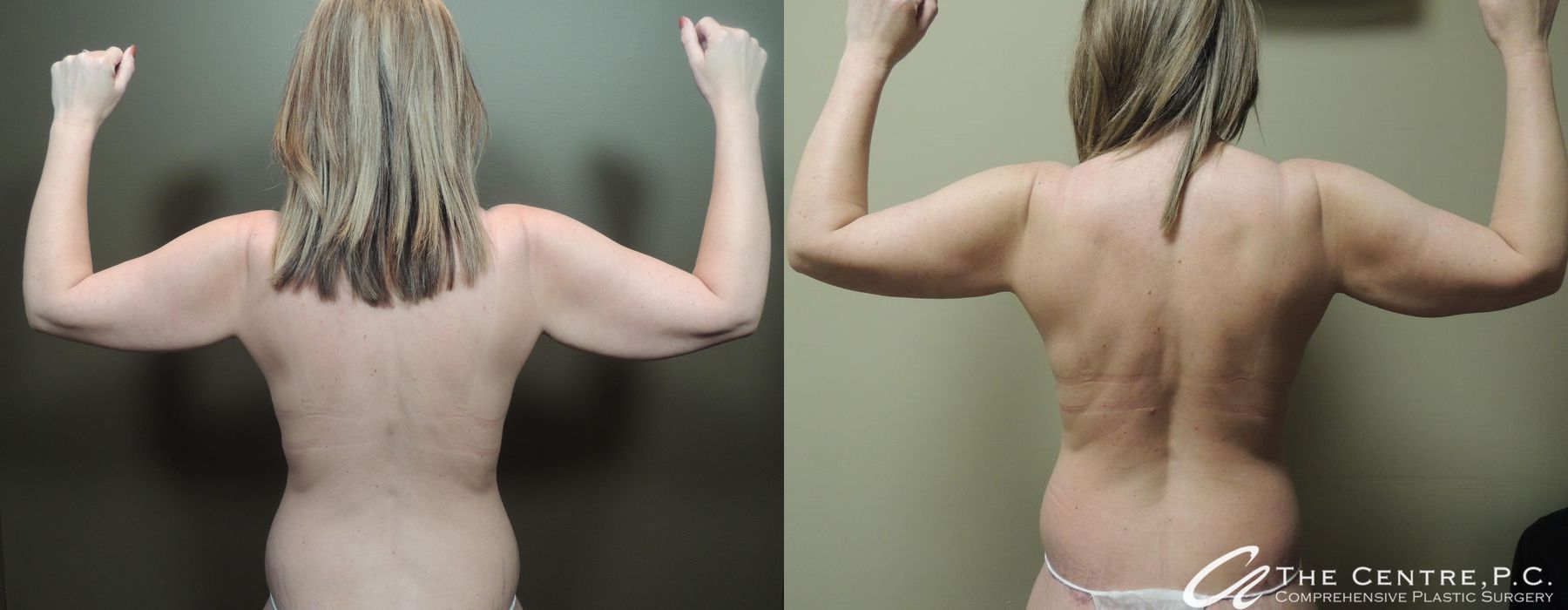 Arm Lift - Case 3417