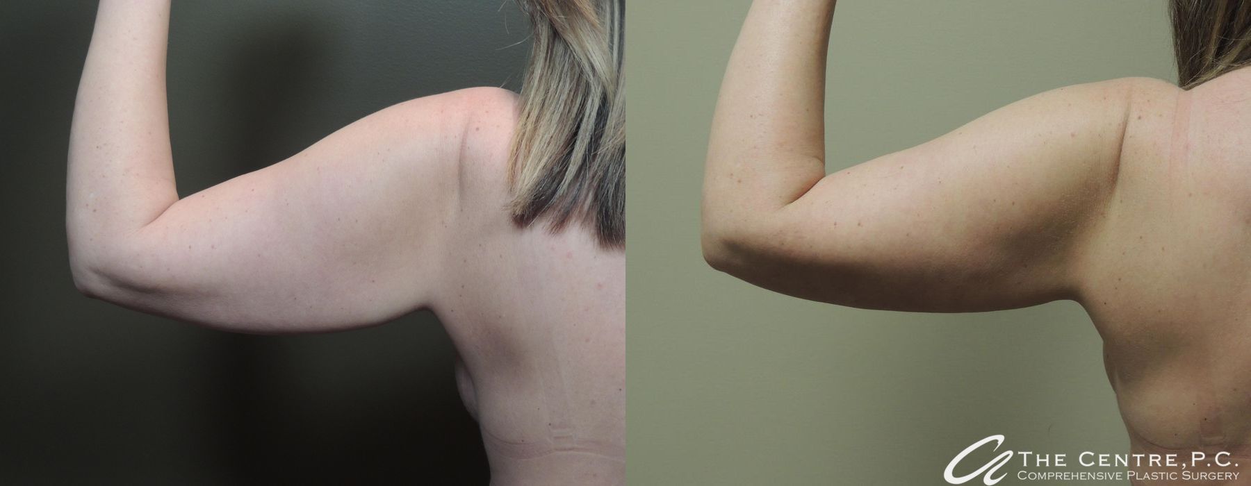 Arm Lift - Thumbnail 3